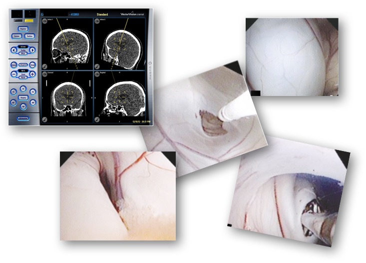 Cavum Septum Pellucidum